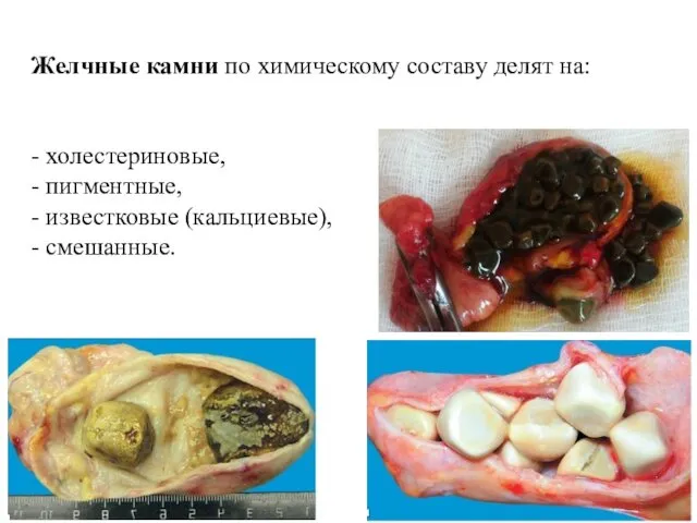 Желчные камни по химическому составу делят на: - холестериновые, - пигментные, - известковые (кальциевые), - смешанные.