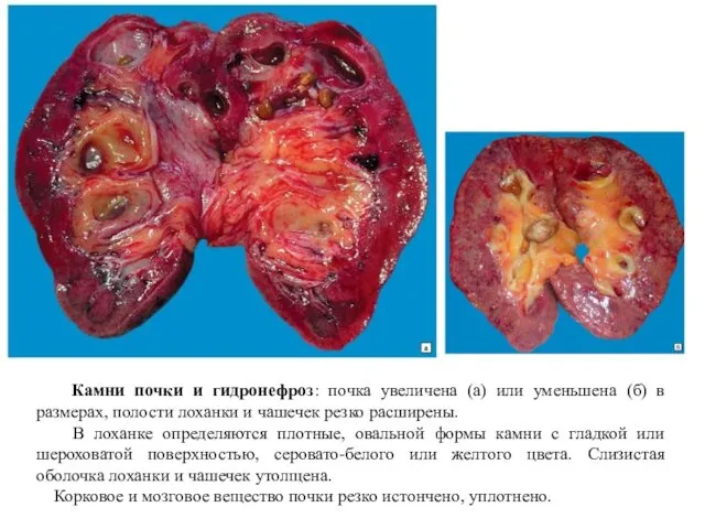 Камни почки и гидронефроз: почка увеличена (а) или уменьшена (б)