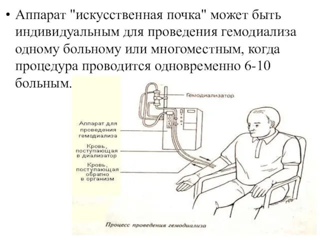 Аппарат "искусственная почка" может быть индивидуальным для проведения гемодиализа одному