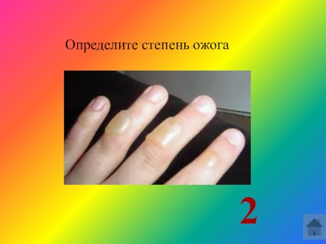 Определите степень ожога 2