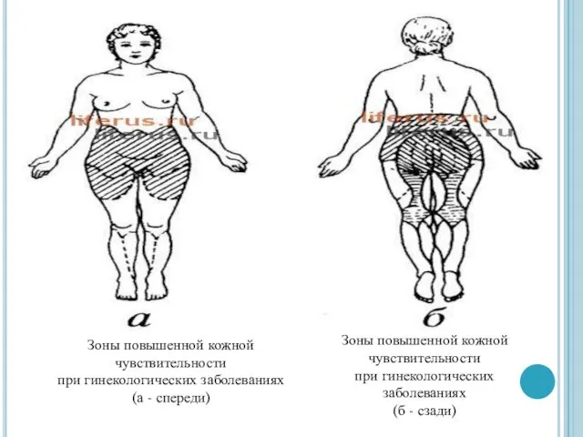 Зоны повышенной кожной чувствительности при гинекологических заболеваниях (а - спереди)