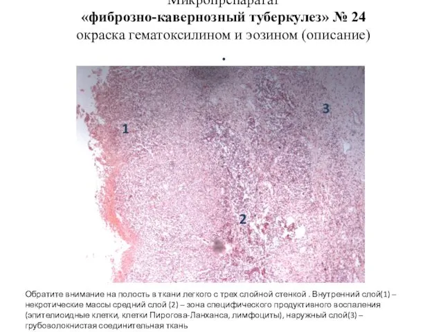 Микропрепаратат «фиброзно-кавернозный туберкулез» № 24 окраска гематоксилином и эозином (описание) . 2 1