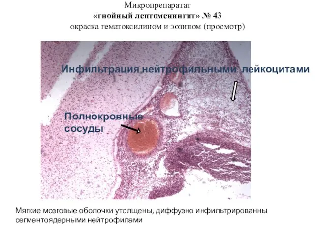 Микропрепаратат «гнойный лептоменингит» № 43 окраска гематоксилином и эозином (просмотр) Инфильтрация нейтрофильными лейкоцитами