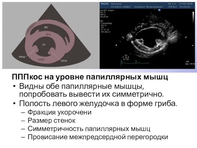 ПППкос на уровне папиллярных мышц Видны обе папиллярные мышцы, попробовать