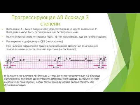 Прогрессирующая АВ блокада 2 степени Выпадение 2 и более подряд