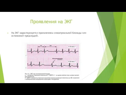 Проявления на ЭКГ На ЭКГ характеризуется проявлением синоатриальной блокады или остановкой предсердий.