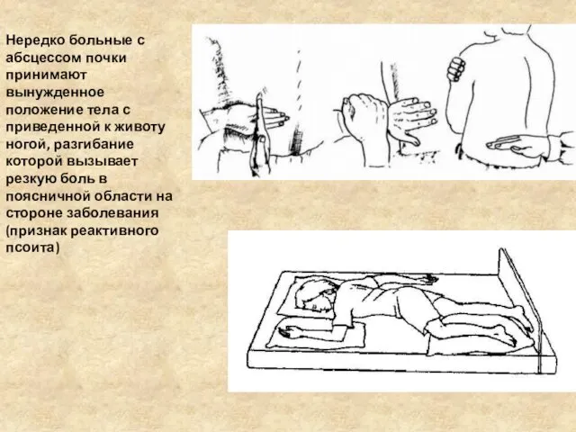 Нередко больные с абсцессом почки принимают вынужденное положение тела с