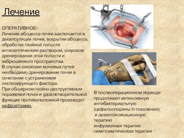 Лечение В послеоперационном периоде продолжают интенсивную антибактериальную (цефалоспорины III поколения)