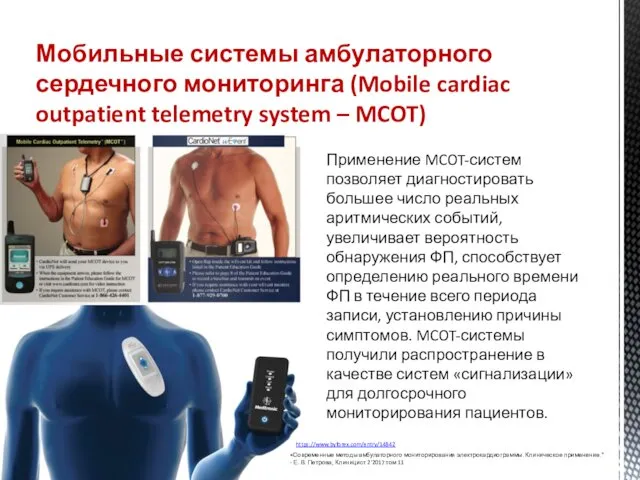 Мобильные системы амбулаторного сердечного мониторинга (Mobile cardiac outpatient telemetry system – MCOT) Применение