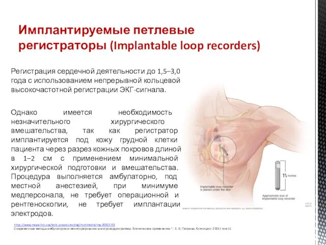 Регистрация сердечной деятельности до 1,5–3,0 года с использованием непрерывной кольцевой