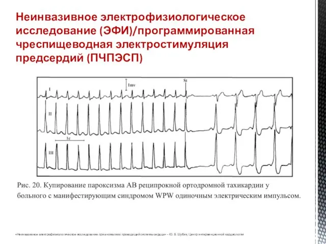 Неинвазивное электрофизиологическое исследование (ЭФИ)/программированная чреспищеводная электростимуляция предсердий (ПЧПЭСП) Имеет определенные