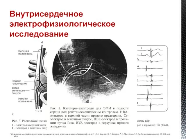 Внутрисердечное электрофизиологическое исследование "Инвазивное электрофизиологичекое исследование: роль в прогнозе внезапной сердечной смерти" -