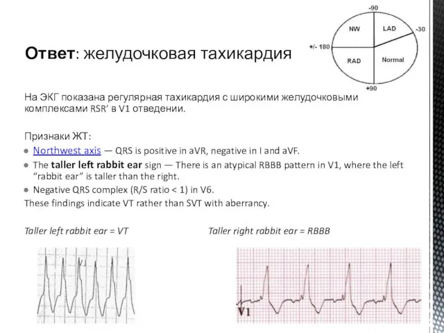 На ЭКГ показана регулярная тахикардия с широкими желудочковыми комплексами RSR’ в V1 отведении.