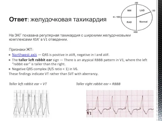 На ЭКГ показана регулярная тахикардия с широкими желудочковыми комплексами RSR’