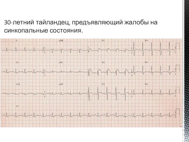 30-летний тайландец, предъявляющий жалобы на синкопальные состояния.