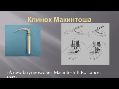 Клинок Макинтоша «A new laryngoscope» Macintosh R.R., Lancet 1943;