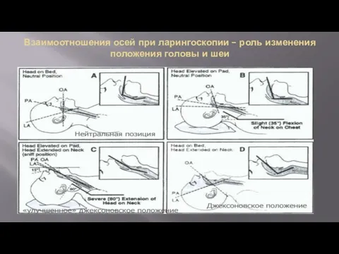 Взаимоотношения осей при ларингоскопии – роль изменения положения головы и шеи