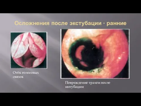 Осложнения после экстубации - ранние Отёк голосовых связок Повреждение трахеи после интубации