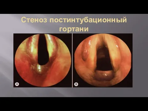 Стеноз постинтубационный гортани