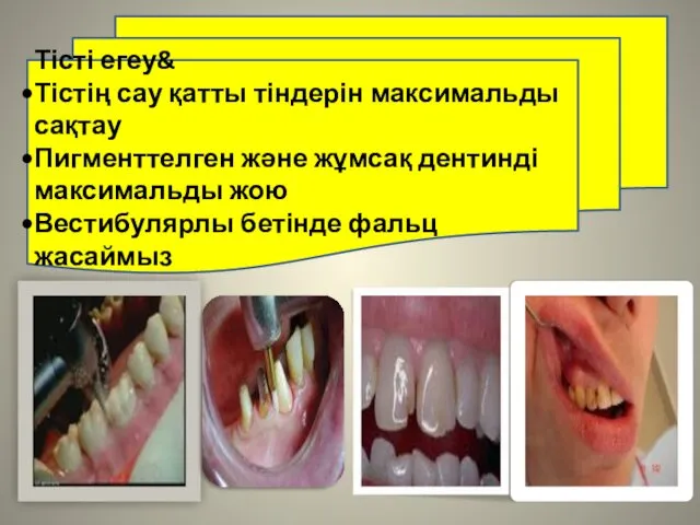 Тісті егеу& Тістің сау қатты тіндерін максимальды сақтау Пигменттелген және