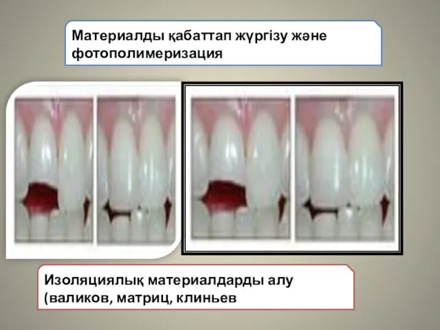 Материалды қабаттап жүргізу және фотополимеризация Изоляциялық материалдарды алу (валиков, матриц, клиньев