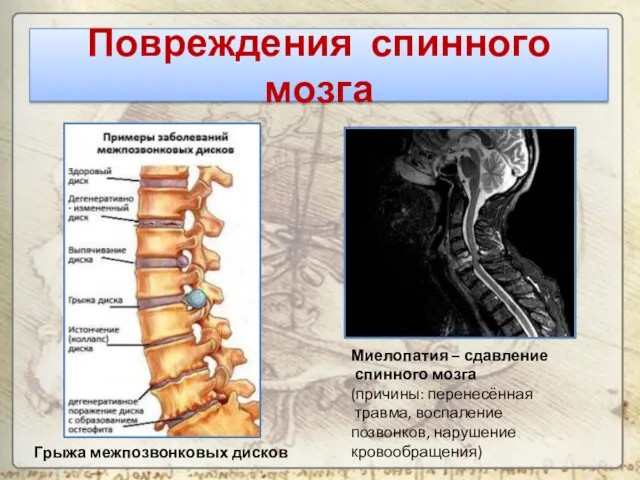 Повреждения спинного мозга Миелопатия – сдавление спинного мозга (причины: перенесённая