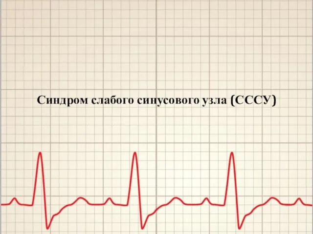 Синдром слабого синусового узла (СССУ)