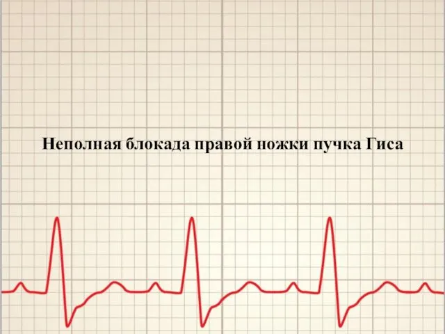 Неполная блокада правой ножки пучка Гиса