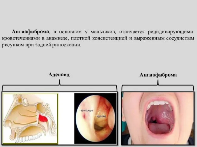 Аденоид Ангиофиброма Ангиофиброма, в основном у мальчиков, отличается рецидивирующими кровотечениями
