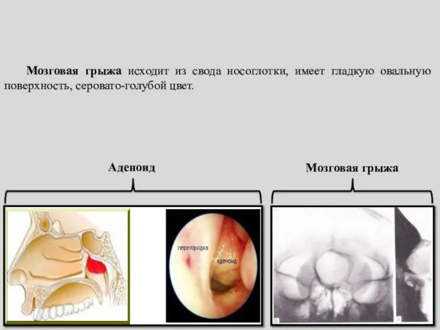 Аденоид Мозговая грыжа Мозговая грыжа исходит из свода носоглотки, имеет гладкую овальную поверхность, серовато-голубой цвет.