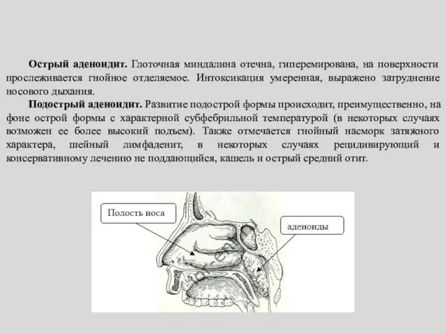 Острый аденоидит. Глоточная миндалина отечна, гиперемирована, на поверхности прослеживается гнойное