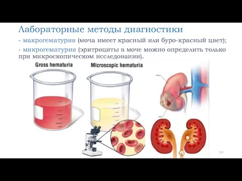 Лабораторные методы диагностики - макрогематурия (моча имеет красный или буро-красный