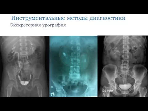 Инструментальные методы диагностики Экскреторная урография