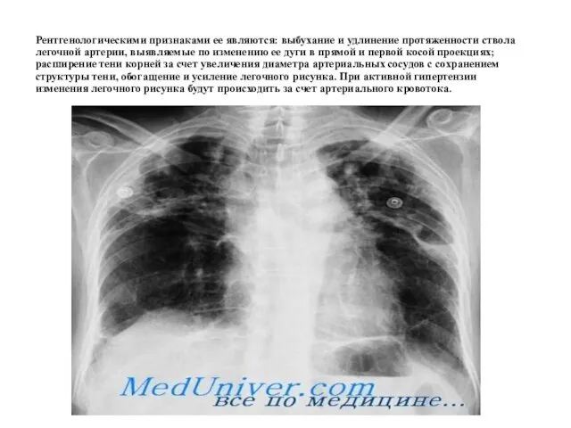 Рентгенологическими признаками ее являются: выбухание и удлинение протяженности ствола легочной