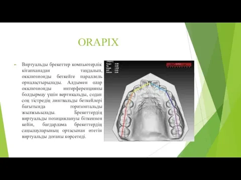 ORAPIX Виртуальды брекеттер компьютерлік кітапханадан таңдалып, окклюзионды беткейге параллель орналастырылады.