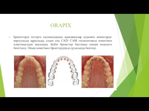 ORAPIX Брекеттерді тістерге тасымалдаушы қақпақшалар алдымен компьтерде виртуальды құрылады, содан