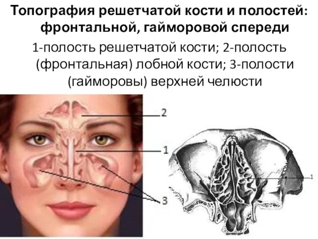 Топография решетчатой кости и полостей: фронтальной, гайморовой спереди 1-полость решетчатой кости; 2-полость (фронтальная)