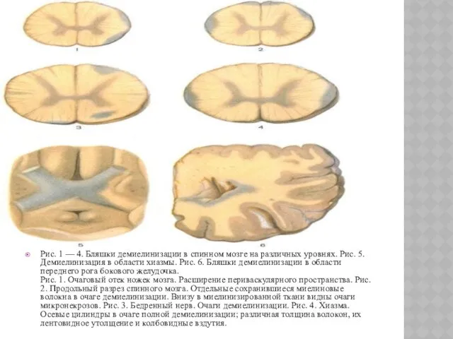 Рис. 1 — 4. Бляшки демиелинизации в спинном мозге на различных уровнях. Рис.