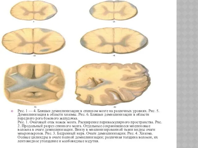 Рис. 1 — 4. Бляшки демиелинизации в спинном мозге на