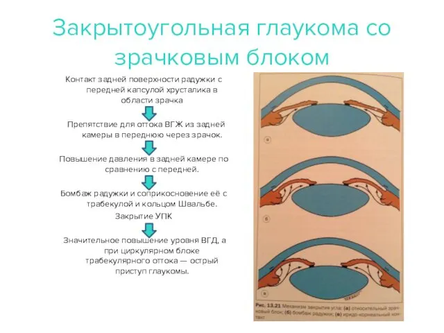 Закрытоугольная глаукома со зрачковым блоком Контакт задней поверхности радужки с