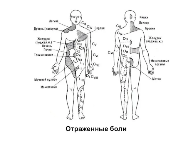 Отраженные боли