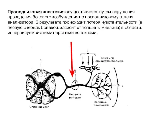 Проводниковая анестезия осуществляется путем нарушения проведения болевого возбуждения по проводниковому