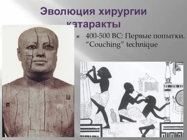 Эволюция хирургии катаракты 400-500 BC: Первые попытки. “Couching” technique