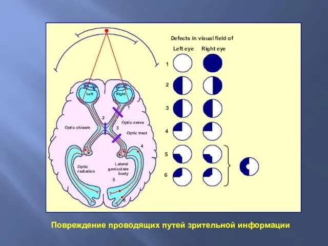 Повреждение проводящих путей зрительной информации