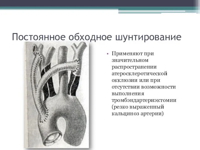 Постоянное обходное шунтирование Применяют при значительном распространении атеросклеротической окклюзии или