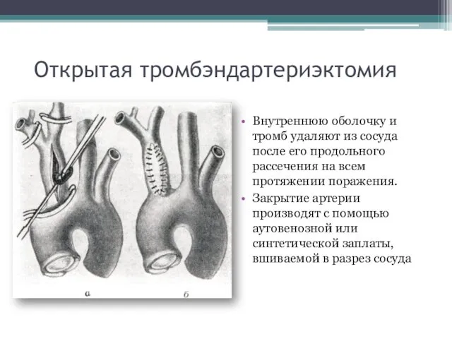 Открытая тромбэндартериэктомия Внутреннюю оболочку и тромб удаляют из сосуда после