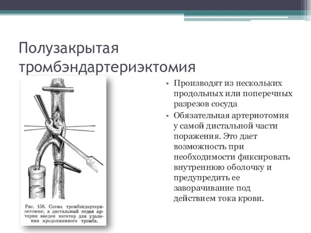 Полузакрытая тромбэндартериэктомия Производят из нескольких продольных или поперечных разрезов сосуда