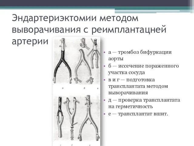 Эндартериэктомии методом выворачивания с реимплантацней артерии а — тромбоз бифуркации