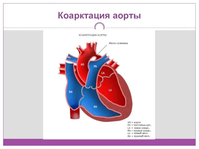 Коарктация аорты