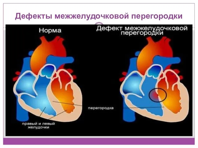 Дефекты межжелудочковой перегородки